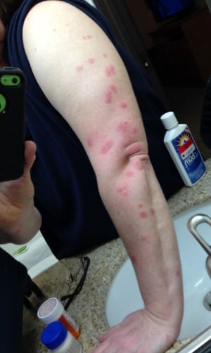 Attorney Secures Settlement for Woman Bit by Bed Bugs at an Oregon Holiday Inn Express  