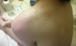 Florida Bed Bug Infestation in Hotel Settlement  